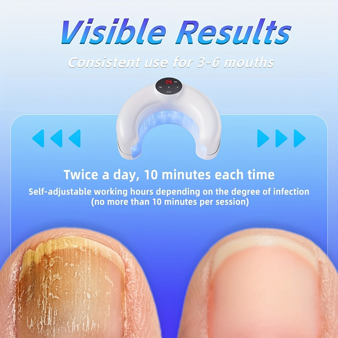 KTS Nail Fungus Cleaning Light Device for Discolored Thickened Toenails Home Treatment for Fingernails Toenails